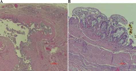 Chronic Cholecystitis With Mucosal Dips Forming Rokitansky Aschoff