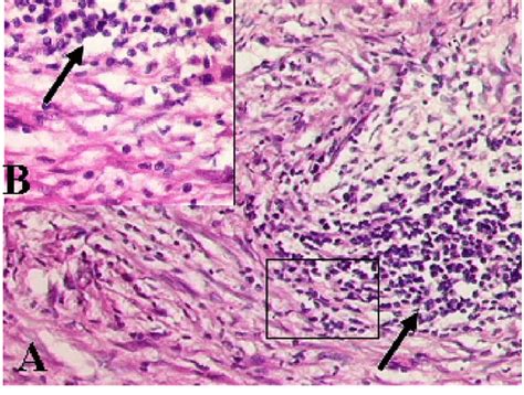 Photomicrographs Reveal Histological Features Of Malignant Fibrous