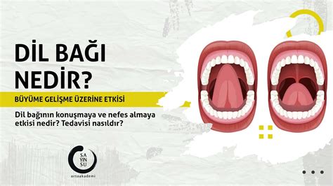 Dil Bağı Nedir Büyüme Gelişim Üzerine Etkisi ve Tedavisi Nasıldır