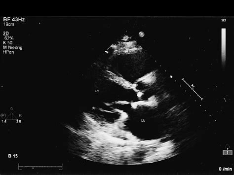 Transthoracic Echocardiography Performed Years After Surgery Lv