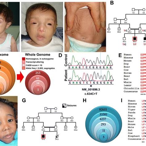 A Unique Syndrome Of Cutis Laxa And Distinct Facies Is Linked To