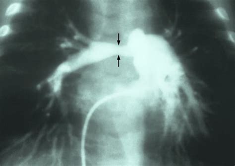 Stenosis of pulmonary artery - Alchetron, the free social encyclopedia