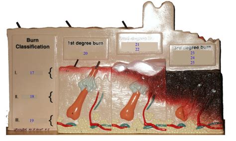 Skin Burn Diagram Quizlet