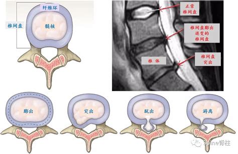 腰椎间盘突出症 更新 椎间盘 根性 神经根 躯体性 症状 健康界