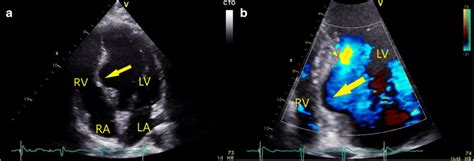 2d Transthoracic Echocardiography Apical 4 Chamber View Of The