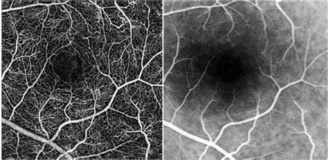 OPHTHALMOLOGY/MEDICAL IMAGING: Retinal imaging advances research ...