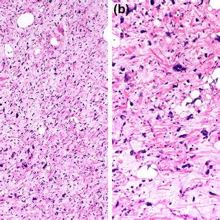 Histopathologic Features Of Pleomorphic Liposarcoma Showing Sheets Of