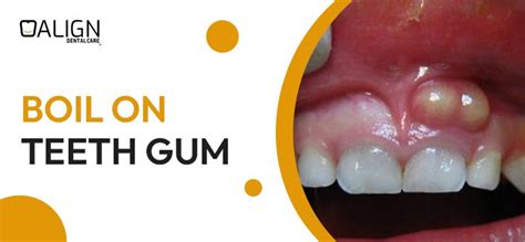 Gum Boils What They Are And How To Treat Them By Align Care Feb