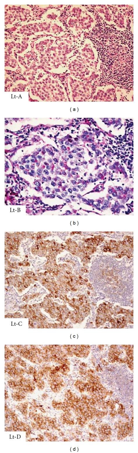 Intra Abdominal Testicular Seminoma In A Woman With Testicular