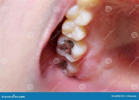 Teeth Cavity with the Treatment Stock Photo - Image of gingiva, cavity: 62896722