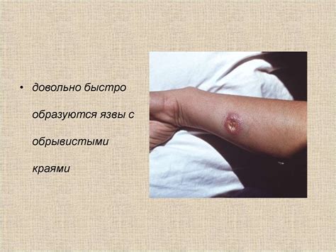 Кожный лейшманиоз - online presentation