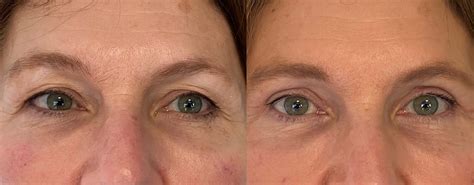 Chirurgie des Paupières Blépharoplastie Lyon Dr KOPPE