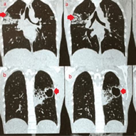 High Resolution Computed Tomography Hrct Of The Chest Showing Download Scientific Diagram