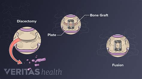 Anterior Cervical Decompression And Spine Fusion Procedure Spine Health