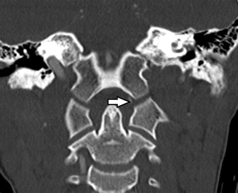 Imaging Of Atlanto Occipital And Atlantoaxial Traumatic Injuries What