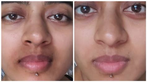 How To Lighten Dark Area Above Upper Lip Sitelip Org