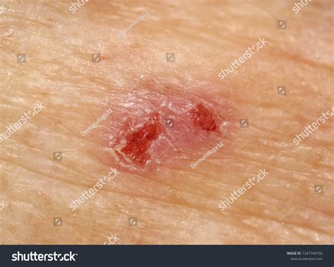 Case Squamous Cell Carcinoma Situ Bowens Foto De Stock Editar Ahora