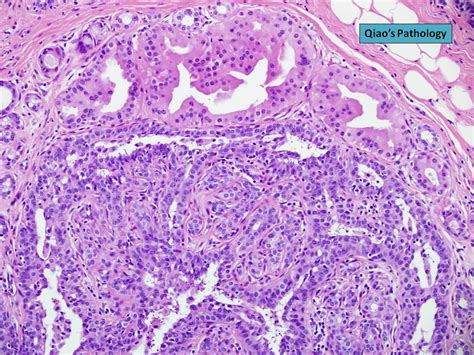 Qiao S Pathology Intraductal Papilloma With Apocrine Metaplasia