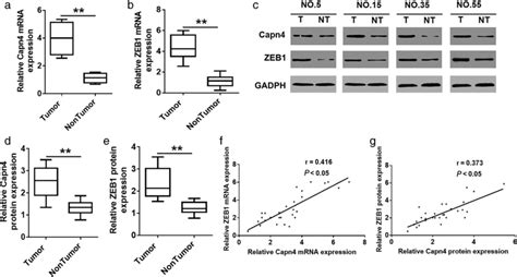 Capn Overexpression Is Correlated With Zeb Expression In Human