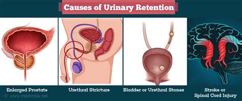 Urinary Retention - Types, Causes, Symptoms, Diagnosis, Treatment & Prevention