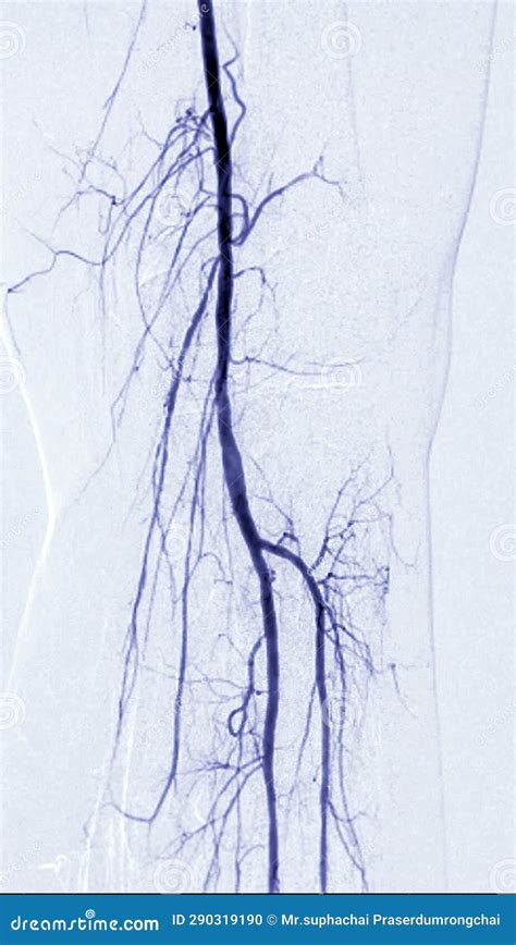 Angiograma De Arteria Femoral O Angiograf A En El Rea De La Rodilla