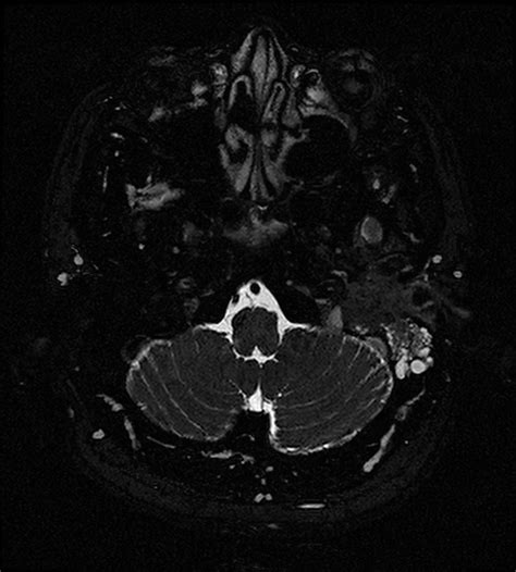 Squamous Cell Carcinoma Of The External Auditory Canal Image