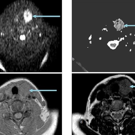 A D MRI Images A Axial DWI B Axial ADC Map C Axial T1WI D