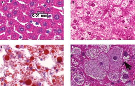 Hepatic Lipidosis Histology