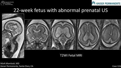 22-week fetus with abnormal prenatal ultrasound | American Society of Pediatric Neuroradiology