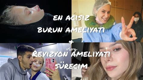 Burun Ameliyatı Sürecim En Acısız Burun AmeliyatıReziyon Ameliyatı