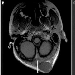 Mri Findings Of Hn Mpnst A Nf Associated Mpnst Of The Pharynx Neck