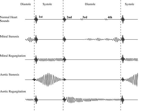 Heart Murmur Diagram Heart Murmurs Take Aurally