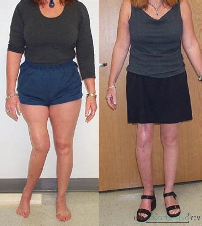 Before After Photos Limb Lengthening Knock Knees Bow Legged