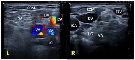 Frontiers Ultrasound Guided Stellate Ganglion Blockade Patient