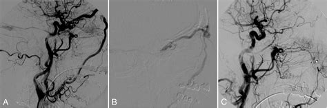 Figure From Transvenous Treatment Of Spontaneous Dural Carotid