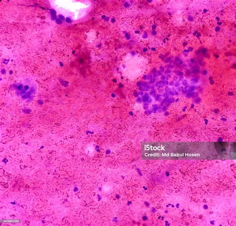 Ct Guided Fna From Lung Lesion Chronic Granulomatous Inflammation With