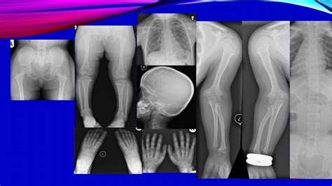 Role Of Medical Imaging In Achondroplasia Dr Muhammad Bin Zulfiqar