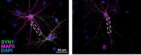 Using Patients Own Cells Researchers Examine Connection Between