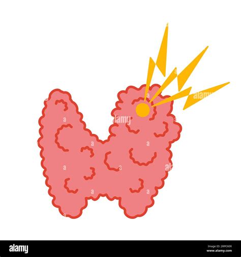 Thyroid Gland With Goiter Body Organ Outline Icon Stock Vector Image