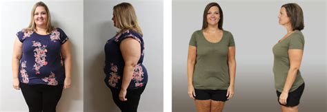 Tracy S Weight Loss Transformation St Louis Bariatrics