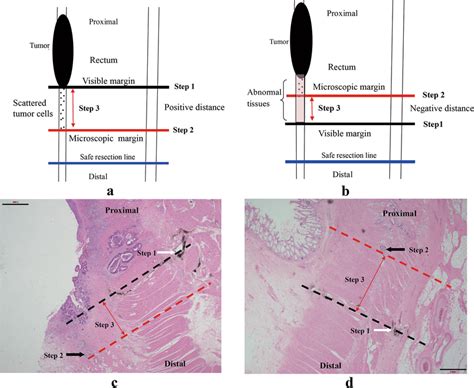 Estimation Of The Intramural Spread Distance Between Visible Margin And