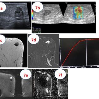 A 68 Year Old Patient Presenting With A Right Breast Lump A US Showed