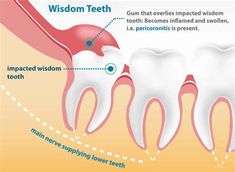 Wisdom Tooth Extraction Gorbatov Dentistry Your Dentist In