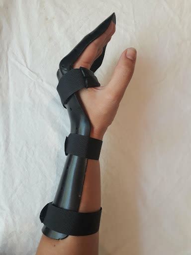 Post Operative Flexor Tendon Rehab Of The Hand Action Rehab