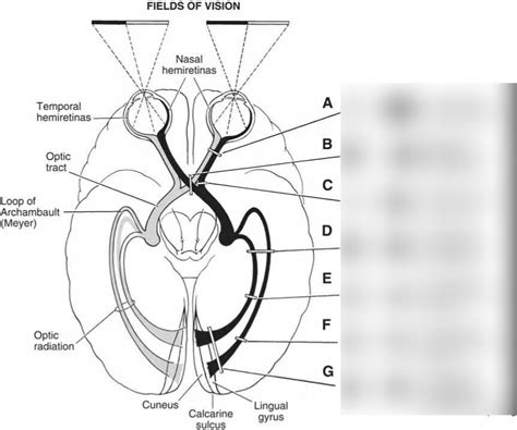 Visual Field Defects Diagram Quizlet