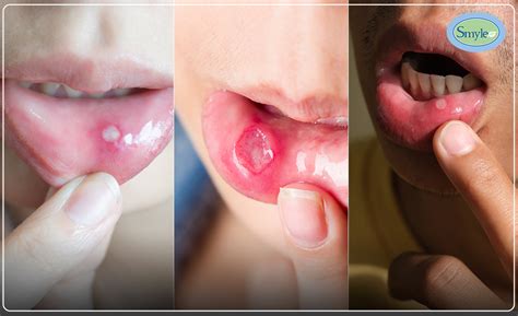 Different Types Of Mouth Ulcer What Are Its Causes And How To Treat