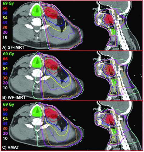 Axial And Sagittal Planning Ct Images Depicting Isodose Distributions