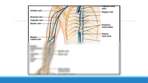 Solution Peripherally Inserted Central Catheter Picc Line Studypool