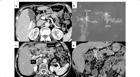 A Multi Detector Row Computed Tomography Mdct Shows A Slightly Download Scientific Diagram