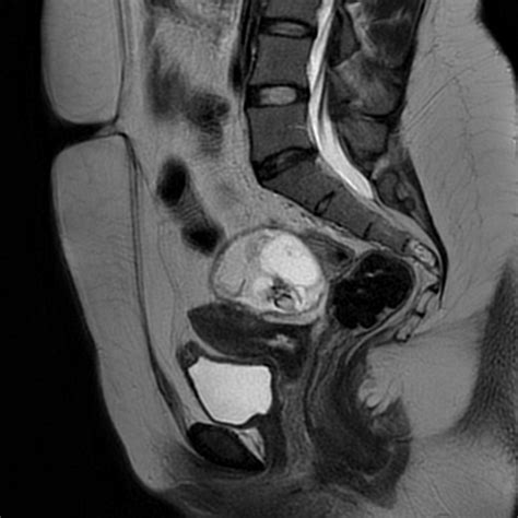 Bilateral Ovarian Dermoid Cysts Image